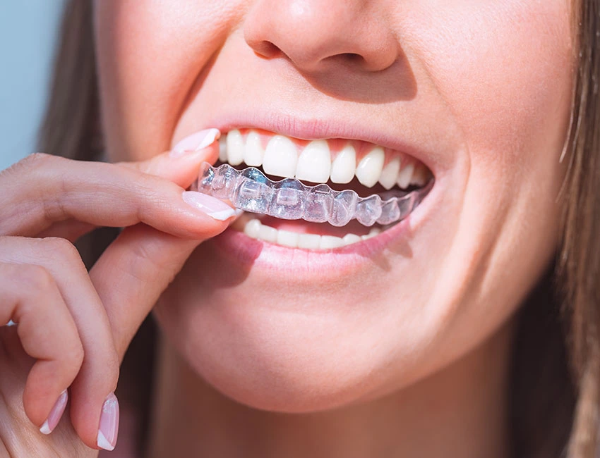Invisalign for Teens  Invisible Braces in Woodland Hills, CA