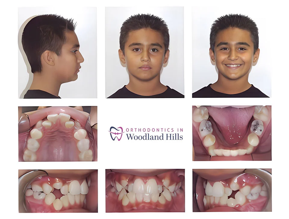 Patient before orthodontic treatment in Woodland Hills, CA
