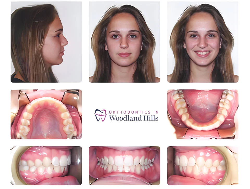 Patient result after orthodontic treatment in Woodland Hills, CA