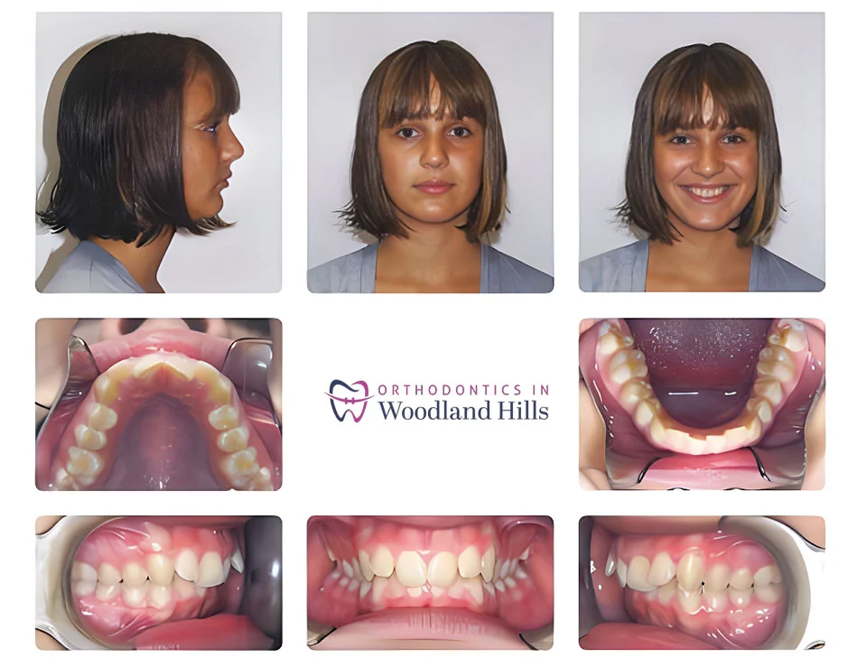 Patient before orthodontic treatment in Woodland Hills, CA