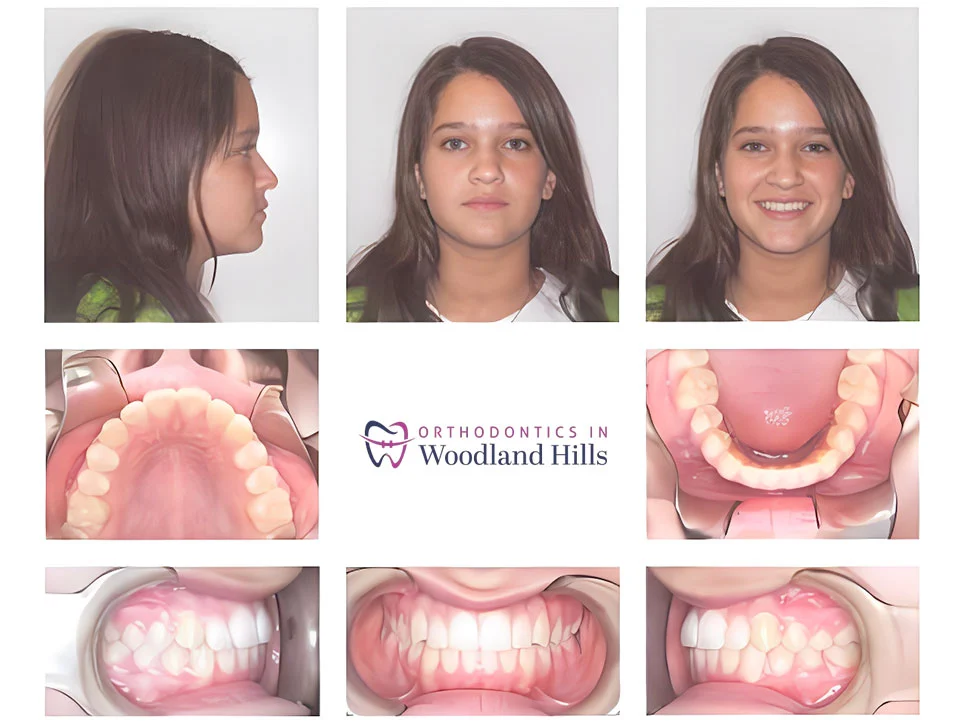 Patient result after orthodontic treatment in Woodland Hills, CA