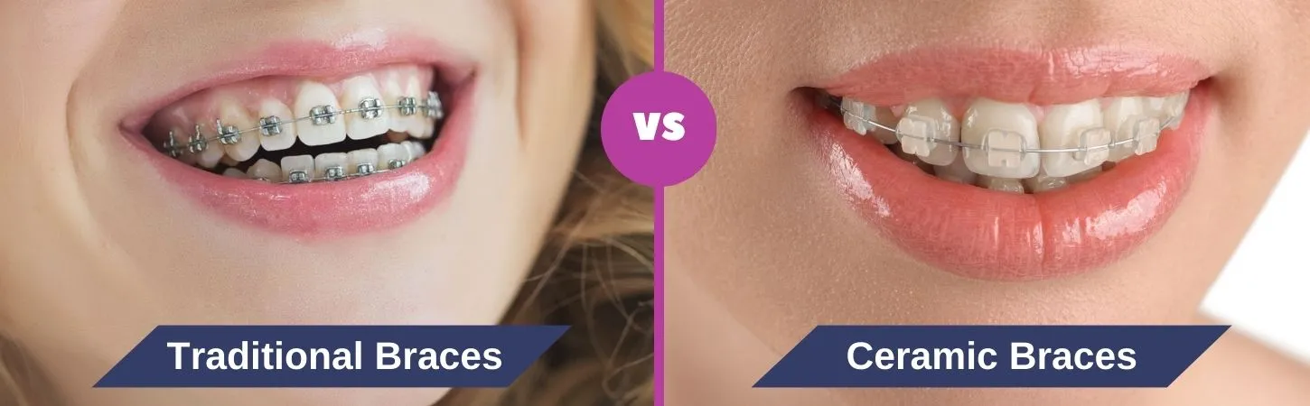 Traditional braces vs clear braces
