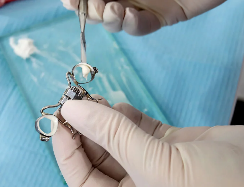 Palatal Expanders at Orthodontics in Woodland Hills office