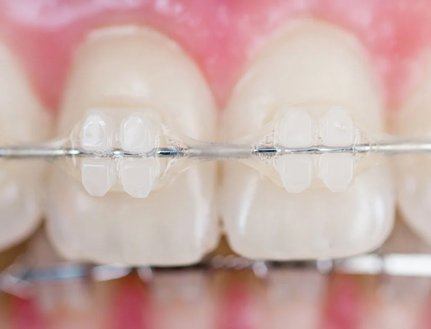 Clear ceramic braces on patient teeth