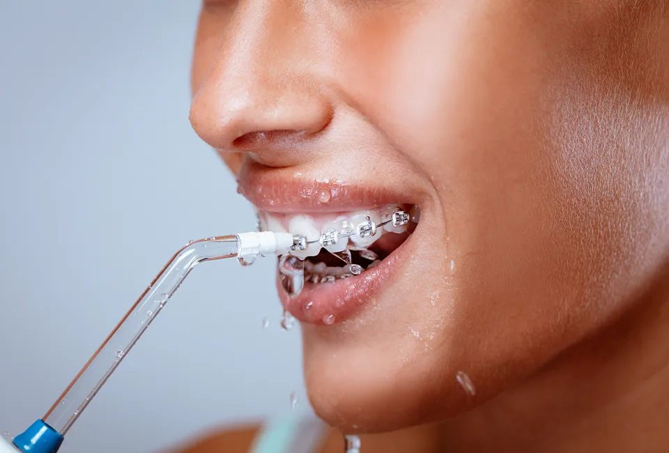 cleaning braces in Woodland Hills, CA